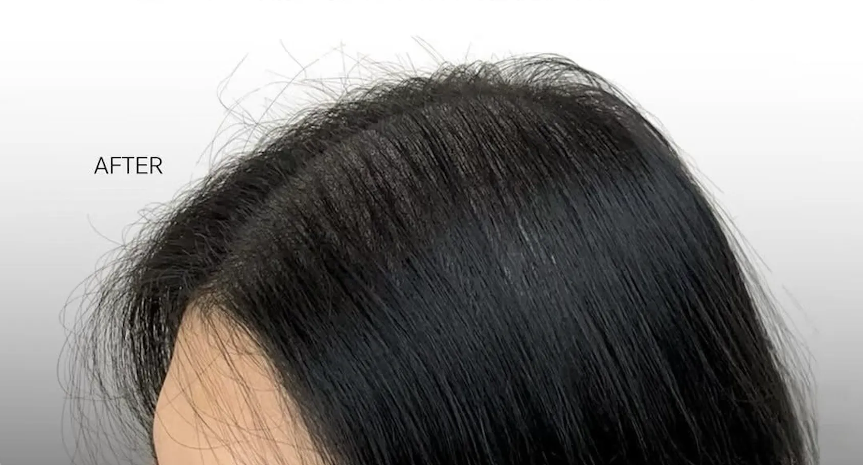 額角、童顏髮際線 After