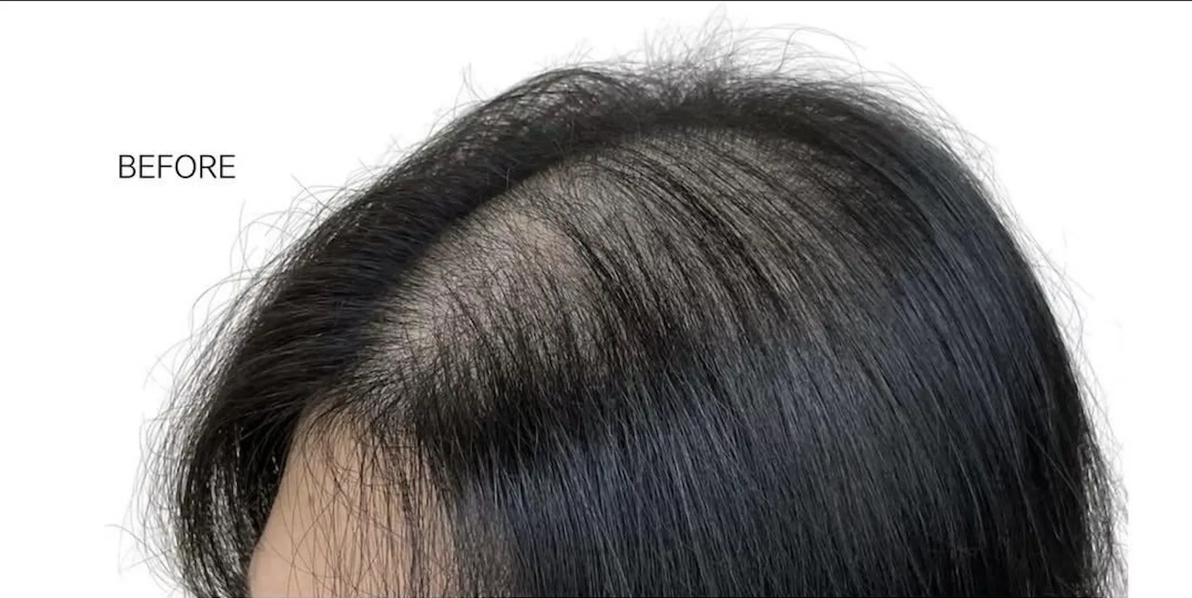 額角、童顏髮際線