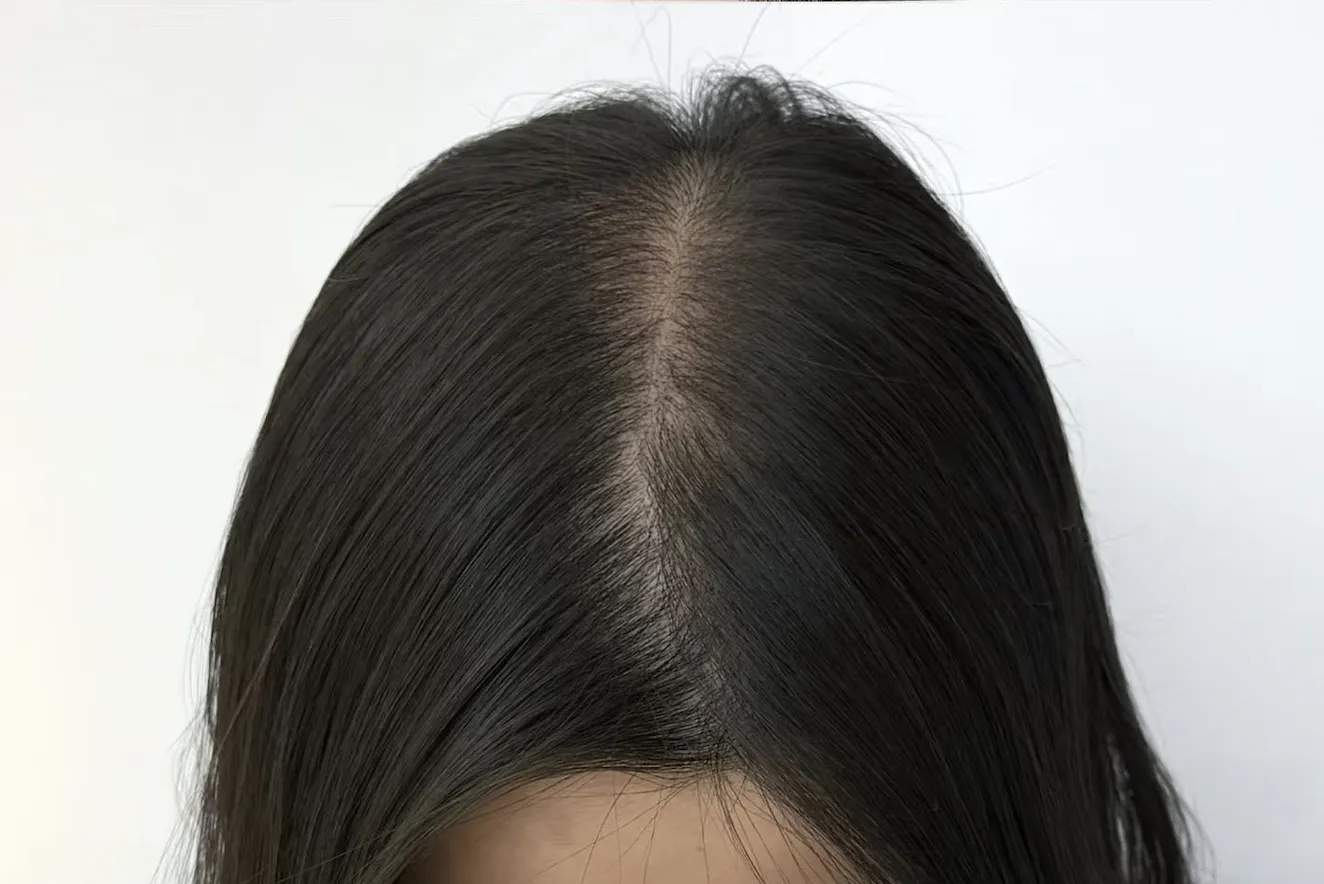 髮線修復