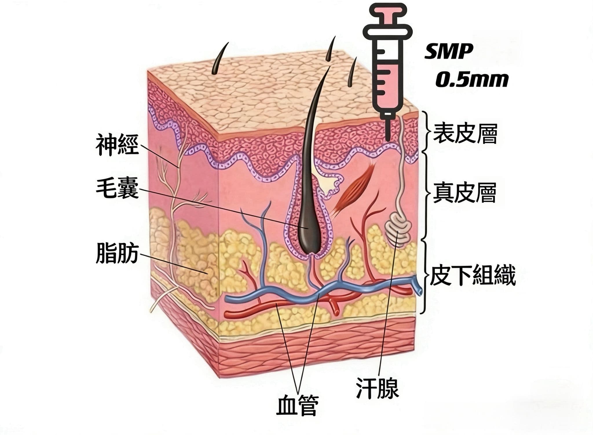 SMP 頭皮微色素技術 — 針頭僅進入表皮層 0.5mm 深度,避開毛囊與神經組織